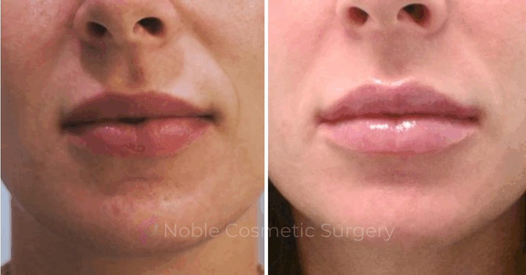 DERMAL FILLERS CASE 00263