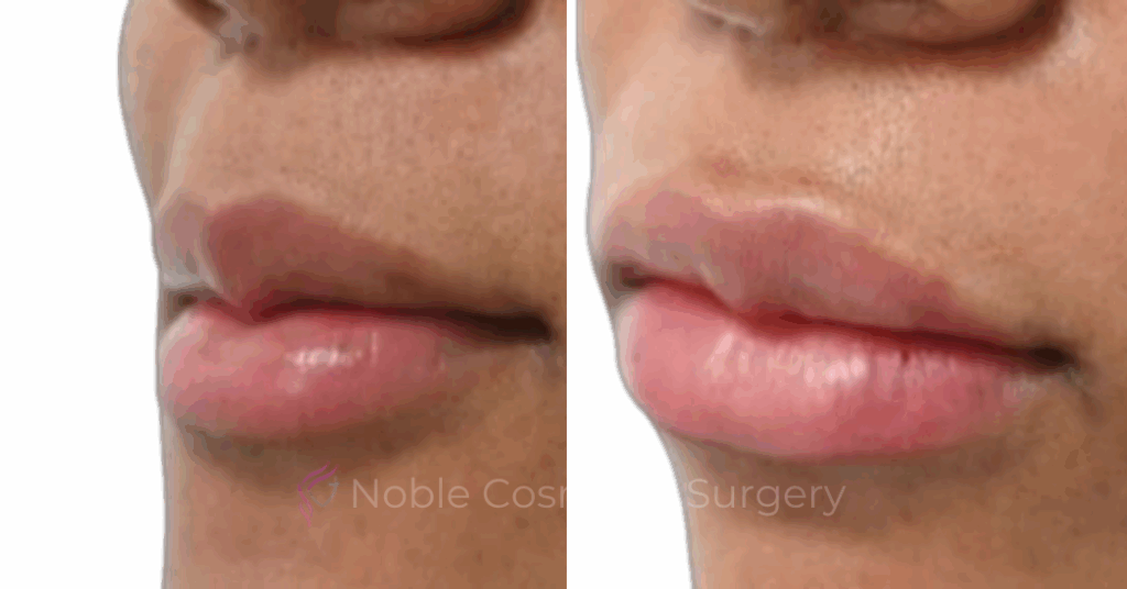 DERMAL FILLERS CASE 00264