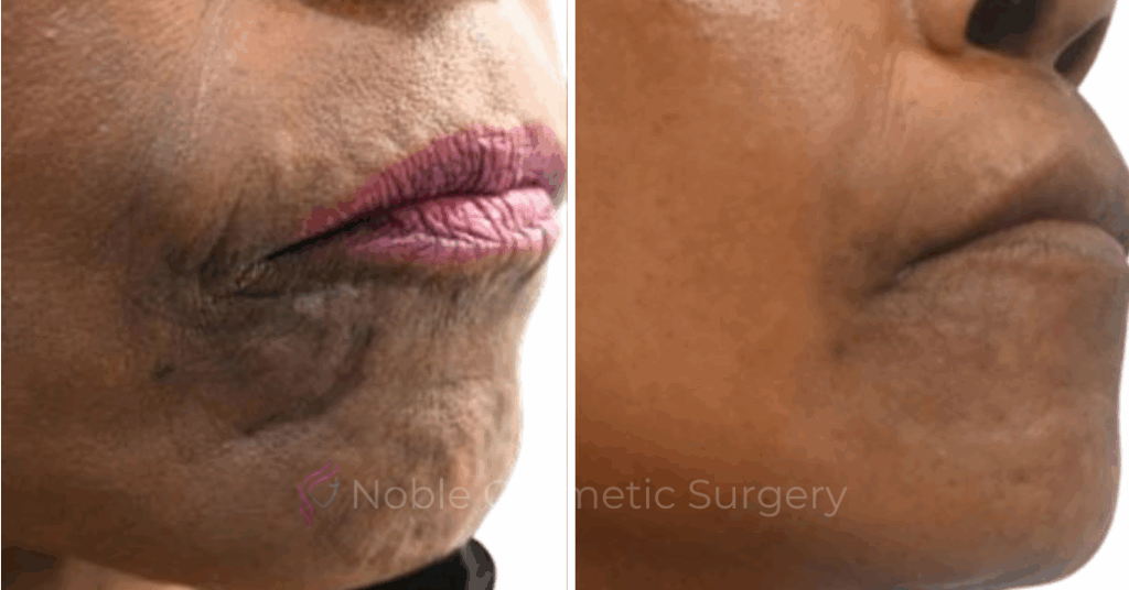 RF MICRONEEDLING CASE 00070