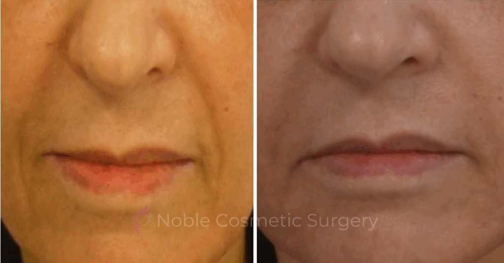 DERMAL FILLERS CASE 00266