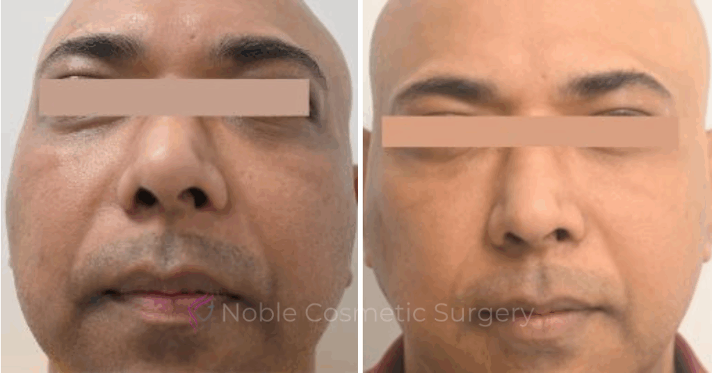 LIQUID RHINOPLASTY CASE 10003