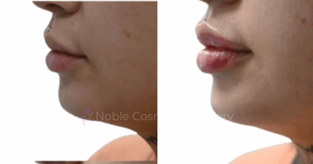 DERMAL FILLERS CASE 00267