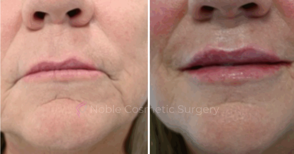 DERMAL FILLERS CASE 00269