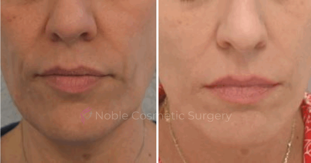 RF MICRONEEDLING  CASE 00060