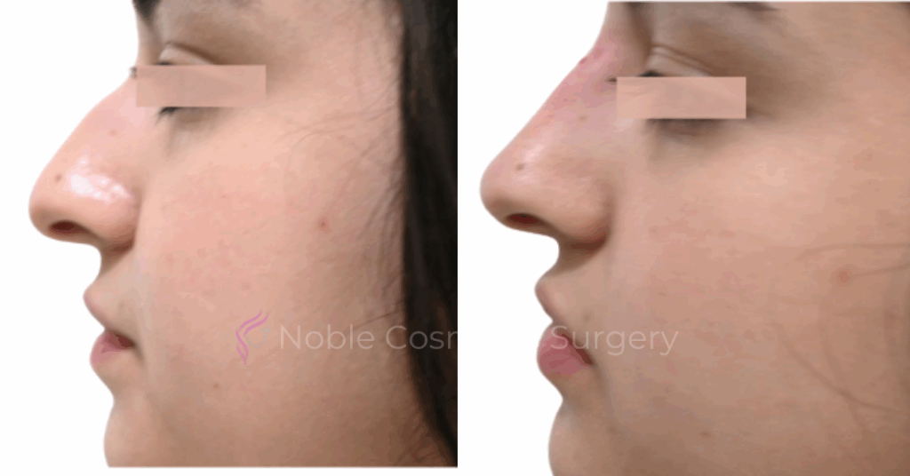 LIQUID RHINOPLASTY CASE 10002