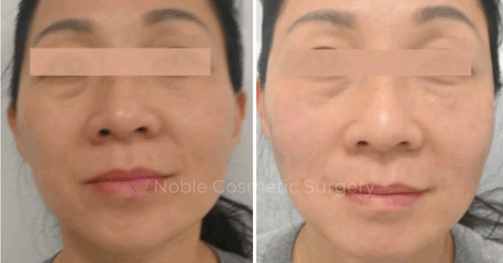 RF MICRONEEDLING CASE 00040