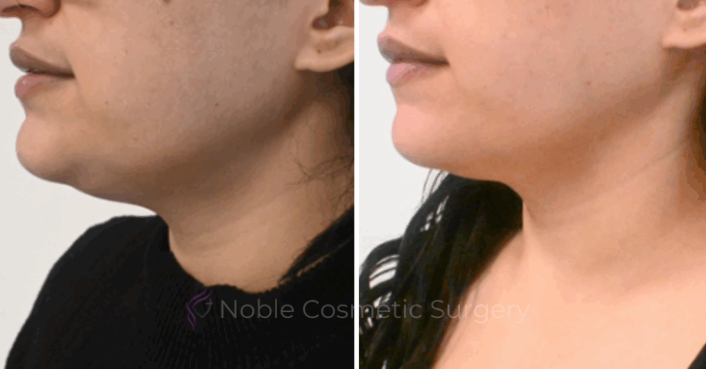 KYBELLA CASE 00100
