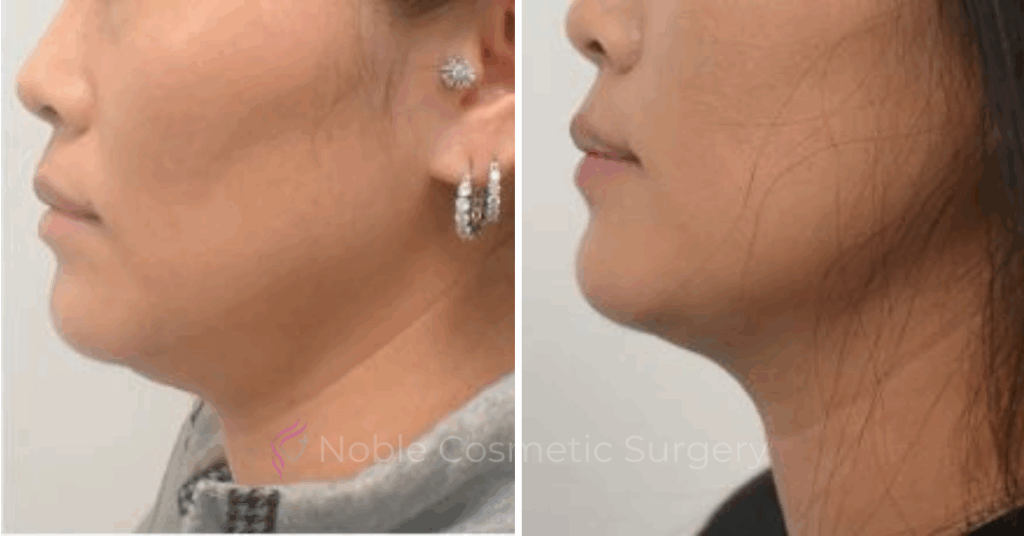 KYBELLA CASE 00300