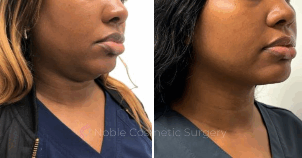 KYBELLA CASE 00400