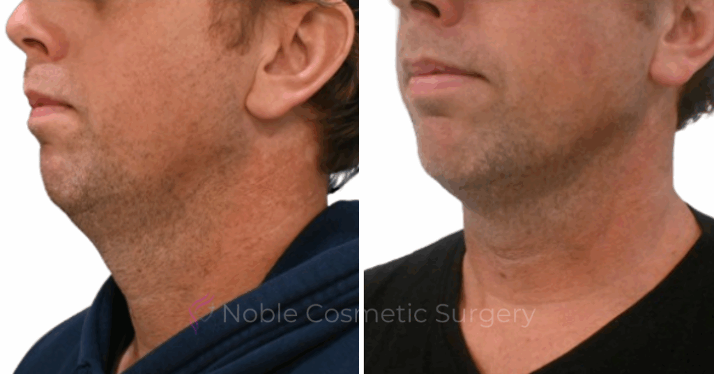 KYBELLA CASE 00500