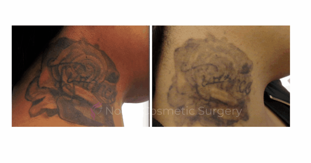 LASER TATTOO REMOVAL CASE 00002