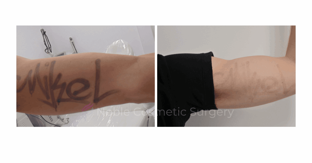 LASER TATTOO REMOVAL CASE 00004