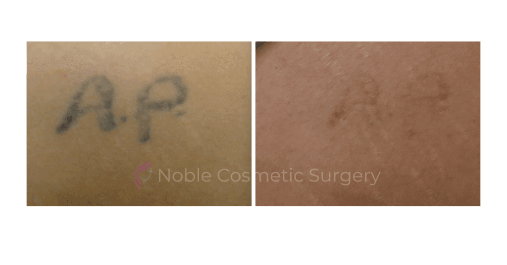 LASER TATTOO REMOVAL CASE 00003