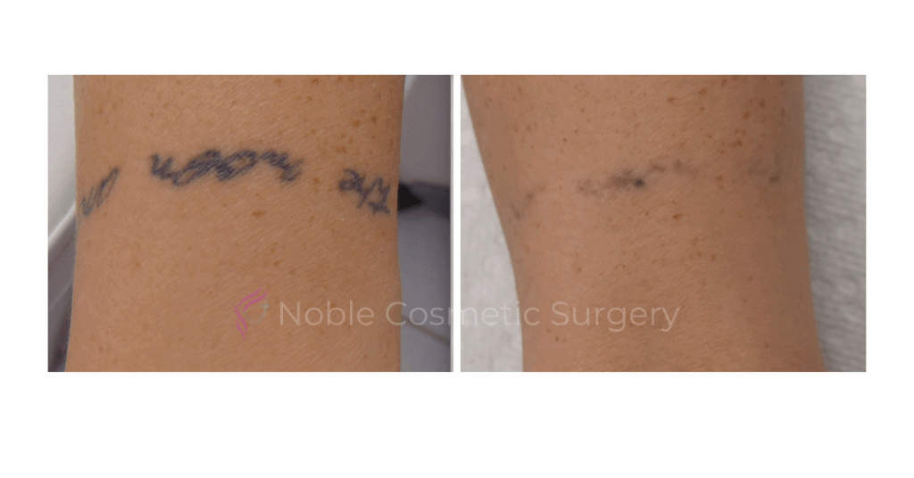 LASER TATTOO REMOVAL CASE 00005