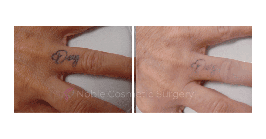 LASER TATTOO REMOVAL CASE 00007