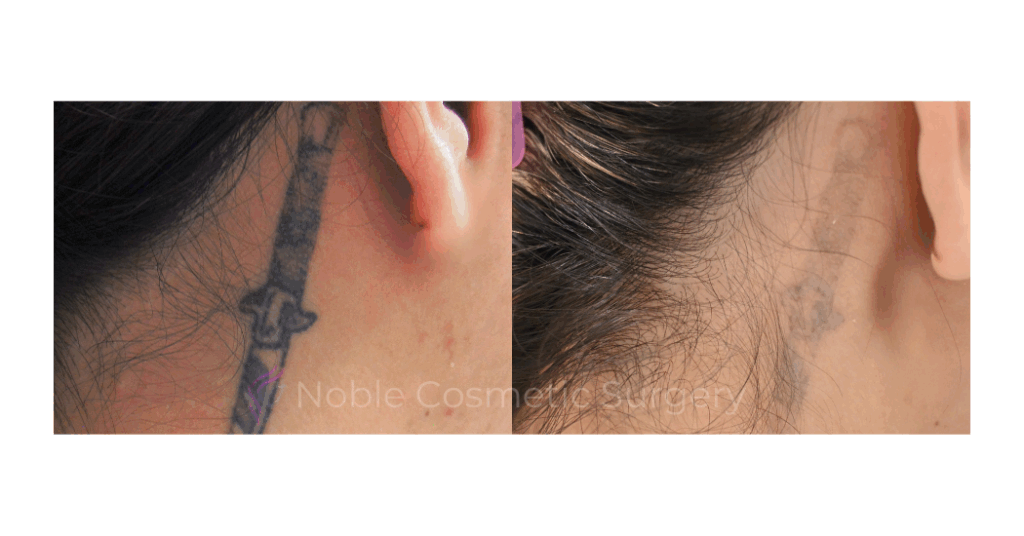 LASER TATTOO REMOVAL CASE 00008