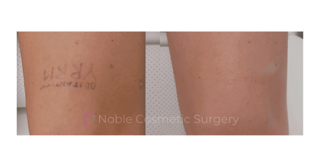 LASER TATTOO REMOVAL CASE 00014