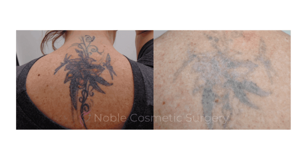 LASER TATTOO REMOVAL CASE 00009