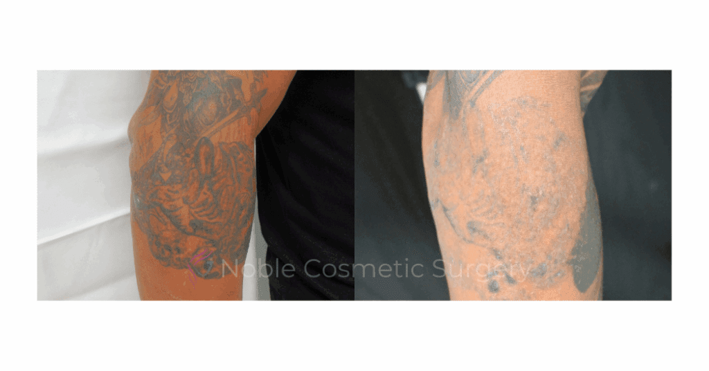 LASER TATTOO REMOVAL CASE 00010