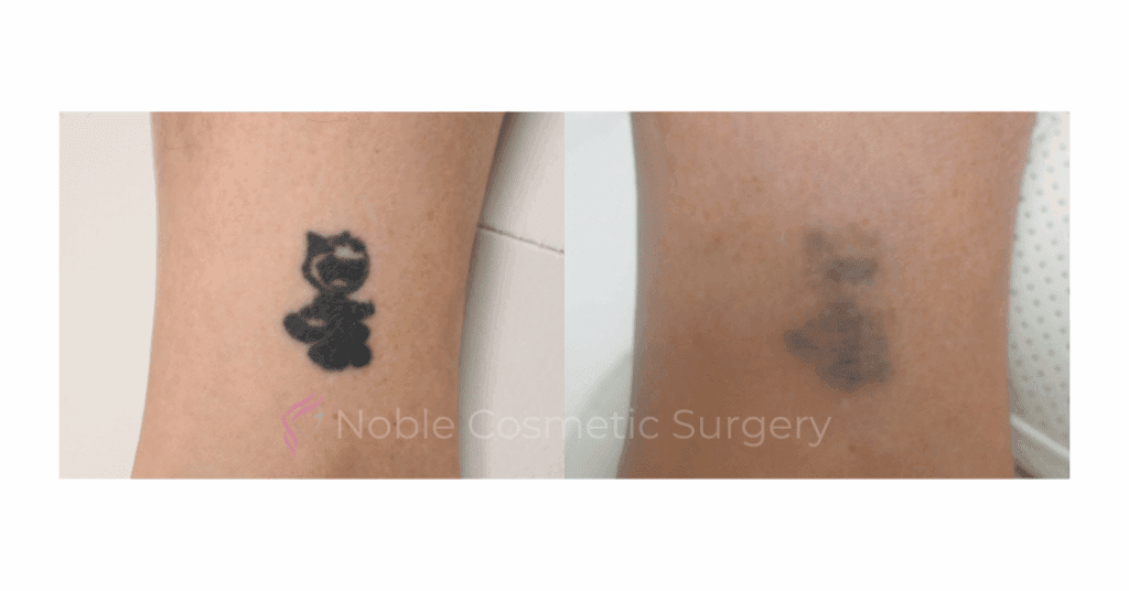 LASER TATTOO REMOVAL CASE 00011