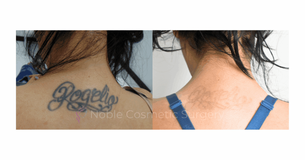 LASER TATTOO REMOVAL CASE 00012