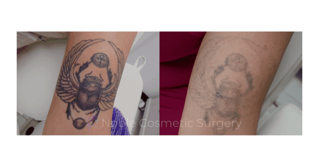 LASER TATTOO REMOVAL CASE 00013