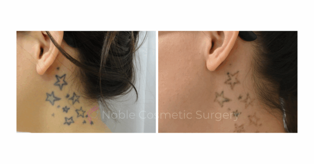 LASER TATTOO REMOVAL CASE 00017