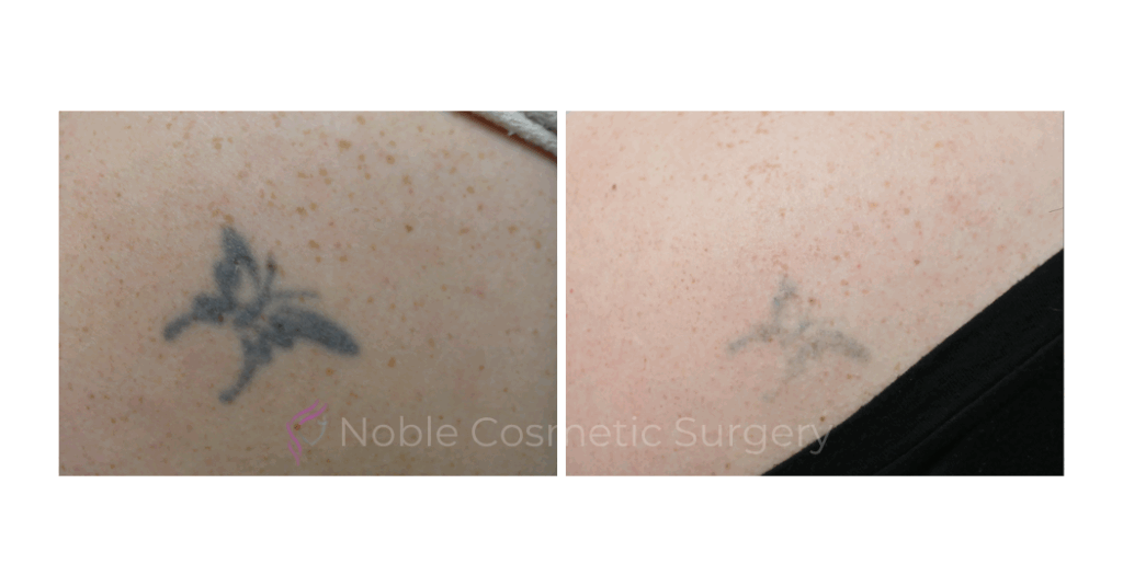 LASER TATTOO REMOVAL CASE 00018