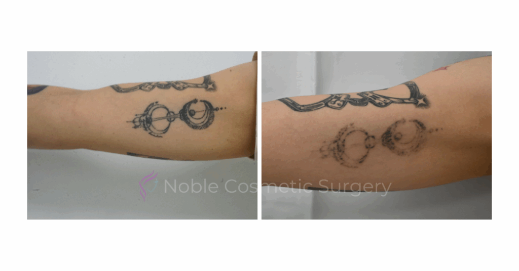 LASER TATTOO REMOVAL CASE 00019