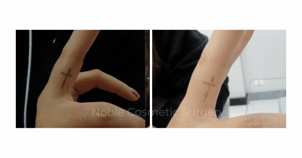 LASER TATTOO REMOVAL CASE 00020
