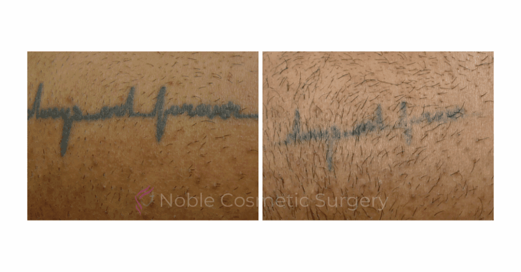 LASER TATTOO REMOVAL CASE 00021