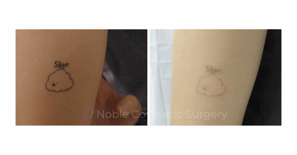 LASER TATTOO REMOVAL CASE 00022