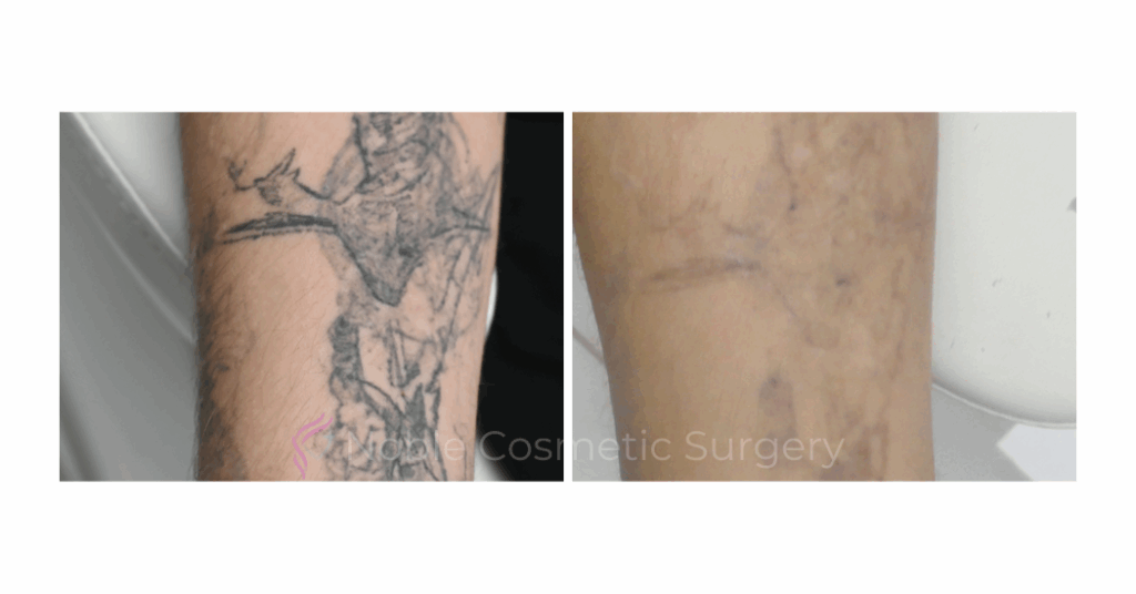 LASER TATTOO REMOVAL CASE 00024