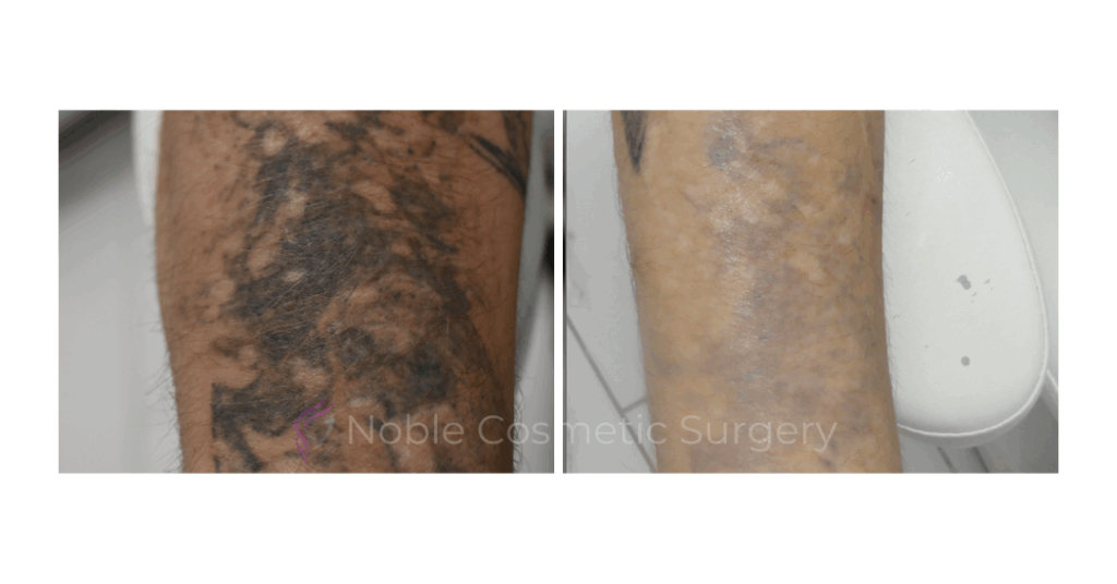 LASER TATTOO REMOVAL CASE 00025