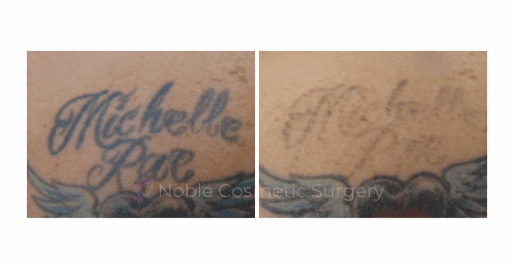 LASER TATTOO REMOVAL CASE 00026
