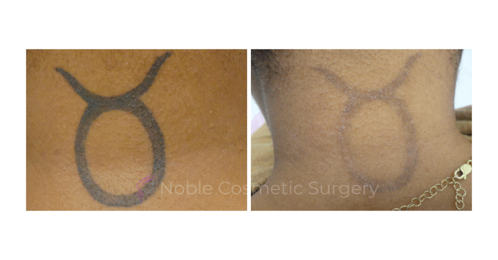 LASER TATTOO REMOVAL CASE 00027