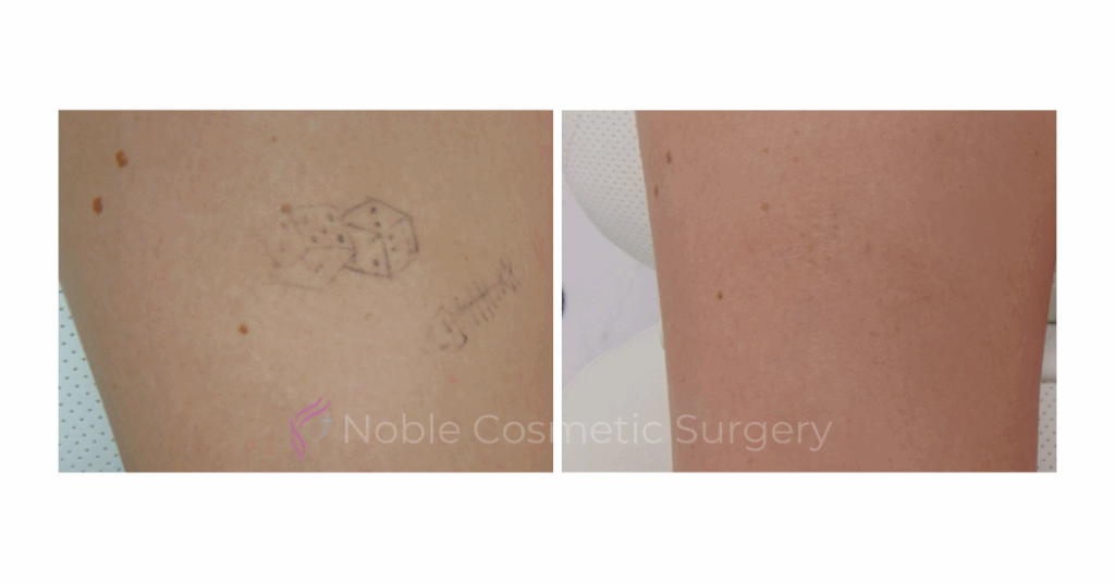 LASER TATTOO REMOVAL CASE 00028