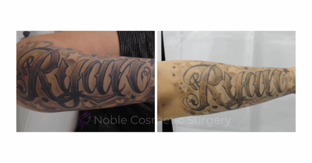 LASER TATTOO REMOVAL CASE 00029