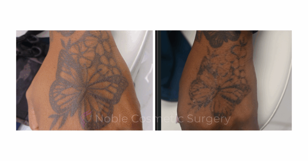 LASER TATTOO REMOVAL CASE 00030