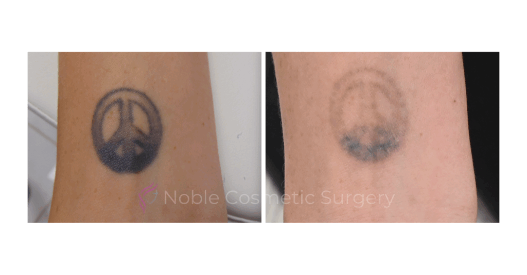 LASER TATTOO REMOVAL CASE 00031