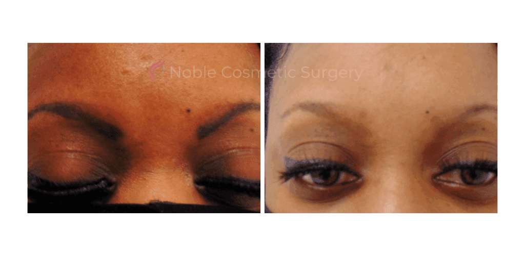 LASER TATTOO REMOVAL CASE 00001