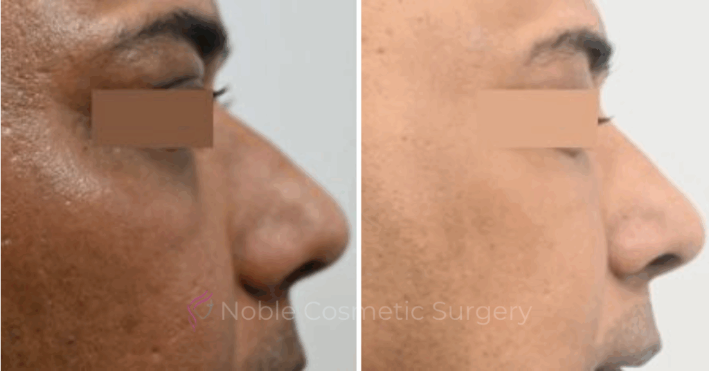 LIQUID RHINOPLASTY CASE 10001
