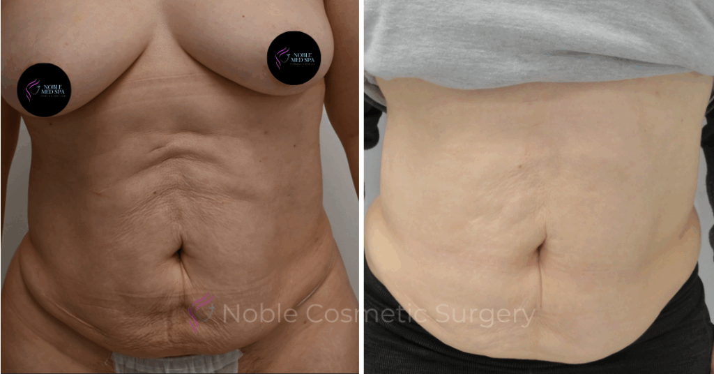 RF MICRONEEDLING  CASE 00010