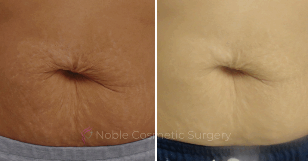 RF MICRONEEDLING  CASE 00020