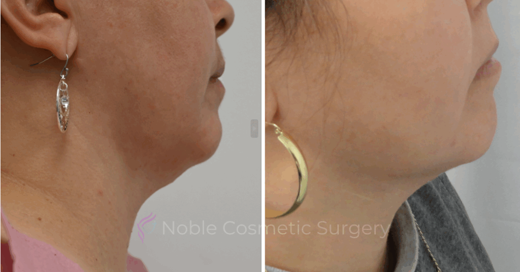RF MICRONEEDLING  CASE 00030