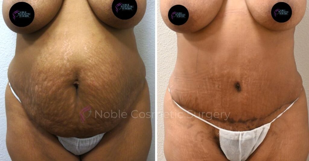 TUMMY TUCK CASE 00033