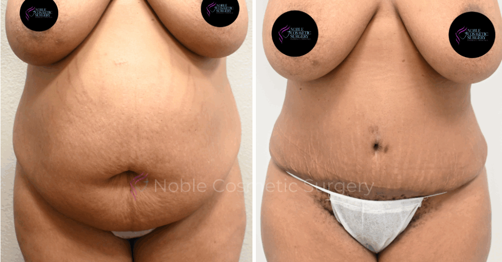 TUMMY TUCK CASE 00035