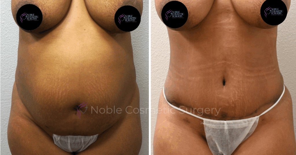 TUMMY TUCK CASE 00034
