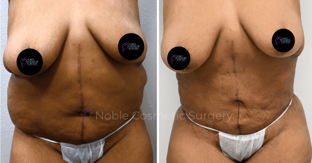 TUMMY TUCK CASE 00036