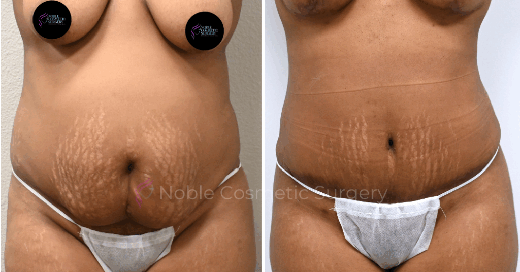 TUMMY TUCK CASE 00037
